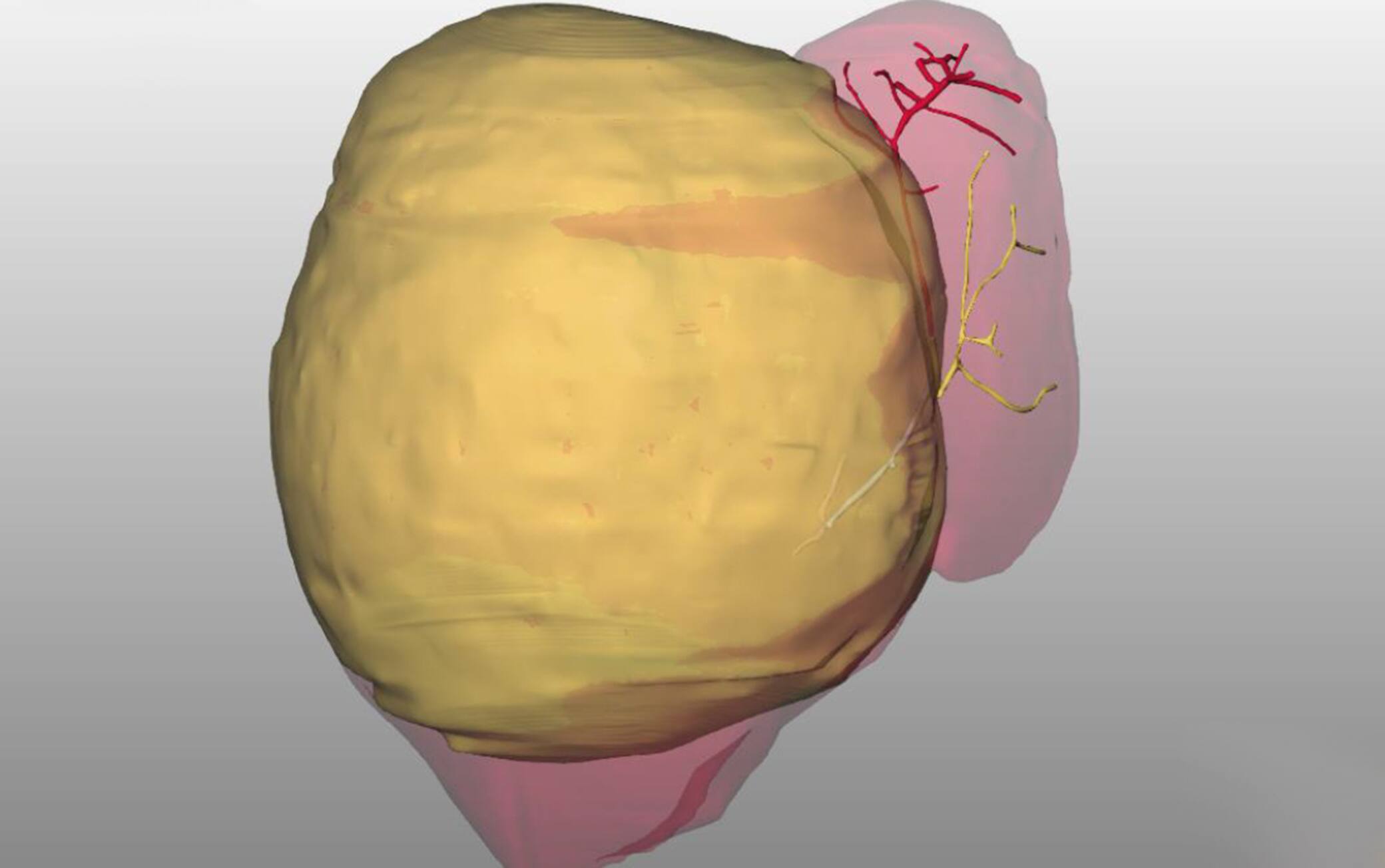 L'immagine 3d della massa tumorale