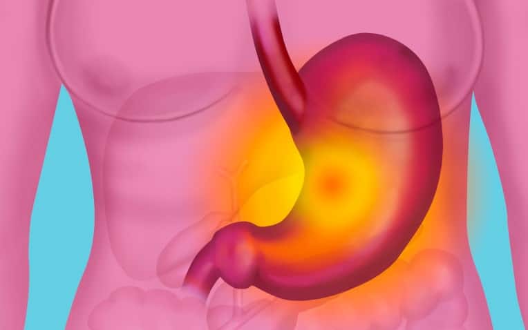 Illustration Of Stomach Disorders Gastric Ulcer, Gastritis, Heartburn. See Images 8509006, 8509106 And 8509306 For Similar Illustrations. (Photo By BSIP/UIG Via Getty Images)