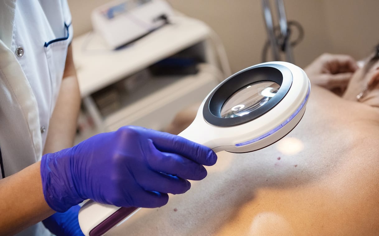 Melanoma in Under 50s: Expert Prevention Tips Beyond Sunscreen