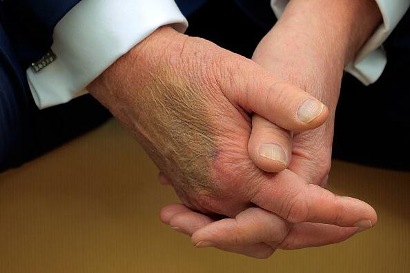 WASHINGTON, DC - FEBRUARY 24: Makeup covers a bruise on the back of U.S. President Donald Trump's hand as he hosts French President Emmanuel Macron for meetings at the White House on February 24, 2025 in Washington, DC. Macron is meeting with Trump in Washington on the third anniversary of Russia's full-scale military invasion of Ukraine. (Photo by Chip Somodevilla/Getty Images)
