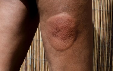 La reazione allergica dopo la puntura