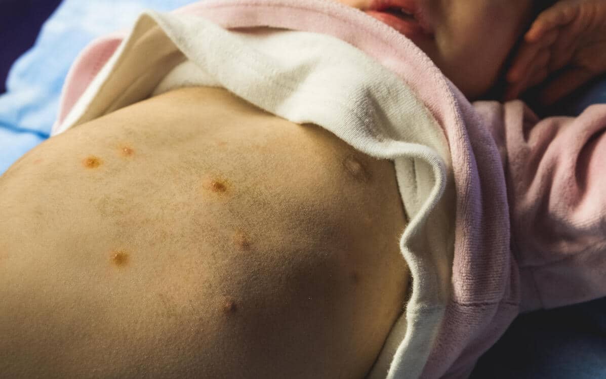 Sintomi e sfogo cutaneo del morbillo