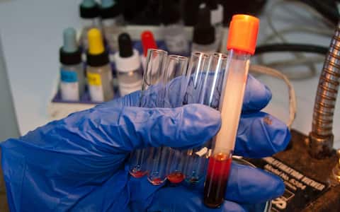 CARACAS, VENEZUELA - JUNE 14: A health worker analyzes volunteers' blood samples in test tubes during the 'World Blood Donor Day' at the Caracas Municipal Blood Bank amid the coronavirus pandemic, on June 14, 2021 in Caracas, Venezuela.