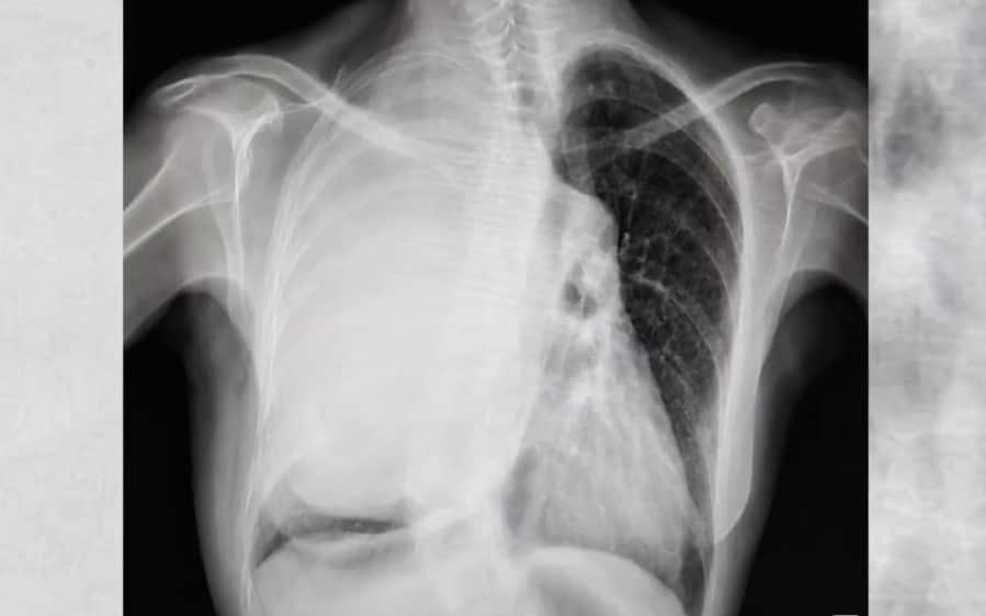 La radiografia della paziente