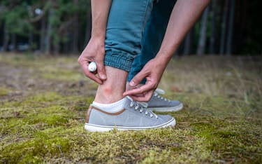2XJA7HH Man with mosquitoes bites itching leg, applying balm on swell skin, suffering from allergic reaction
