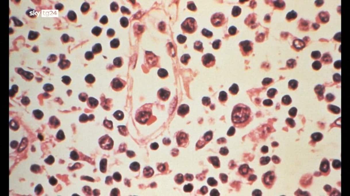 Focolaio Hantavirus, positiva hostess di volo